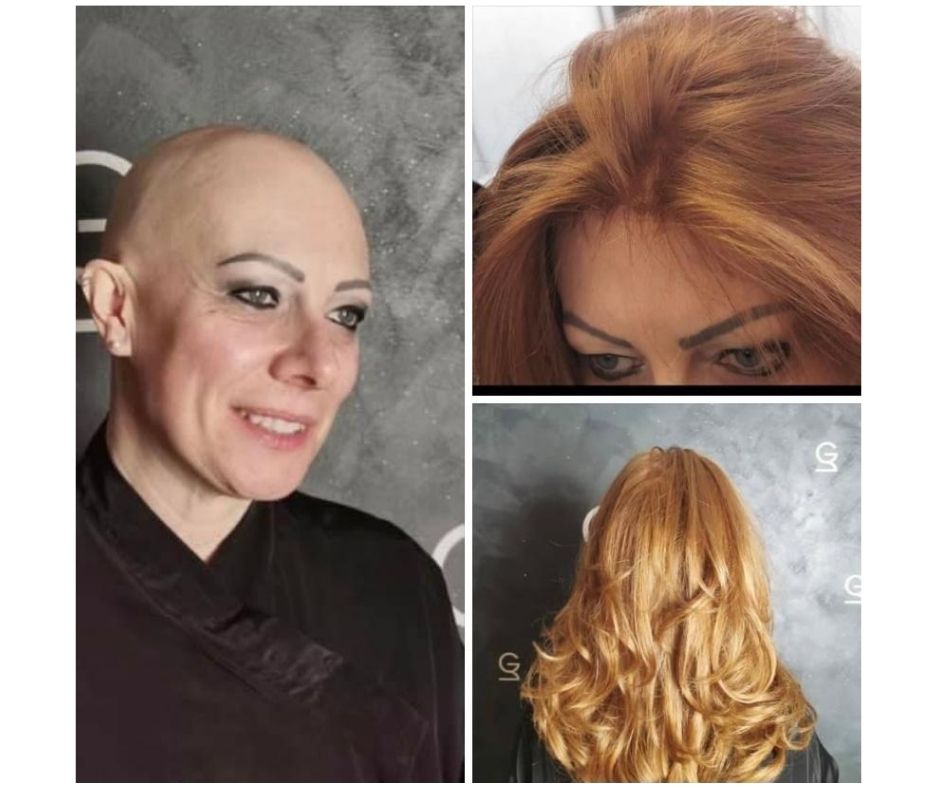 soluzione per alopecia capelli donna