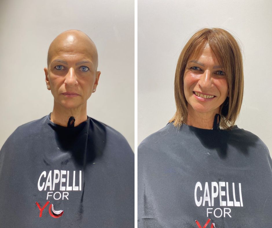 Alopecia totale prima e dopo